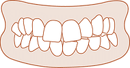 Crowded teeth